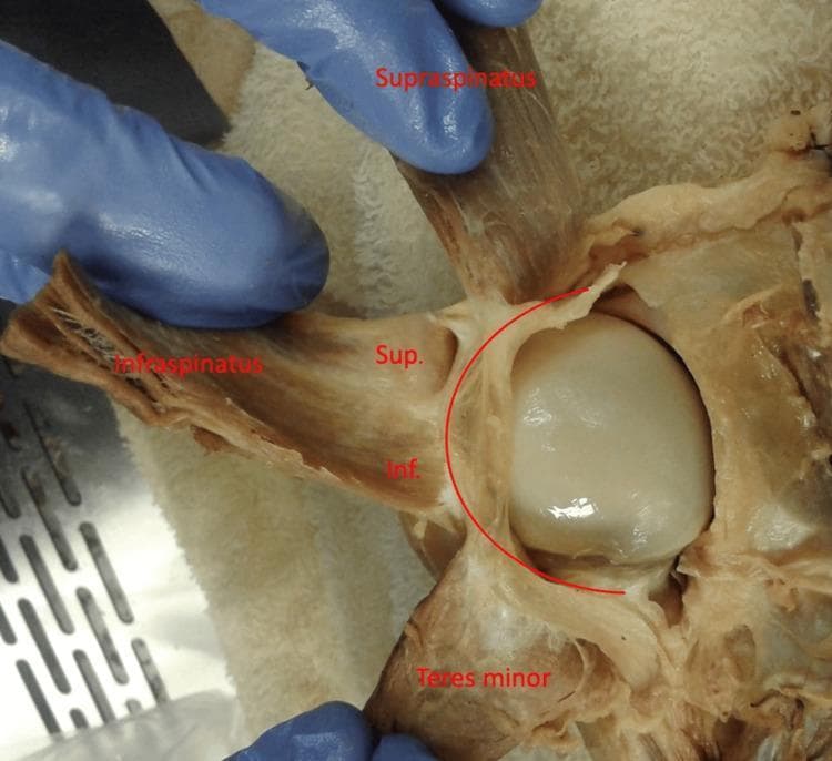 Anatomical Dissection: This clinical photograph provides a posterior view of a dissected left human shoulder, focusing on the rotator cuff complex. The supraspinatus, infraspinatus, and teres minor muscles are reflected laterally to reveal the underlying humeral head and its capsule. A curved red line overlay highlights the rotator cable, a thick fibrous band that spans the avascular zone of the rotator cuff. The infraspinatus muscle is further subdivided with labels 'Sup.' and 'Inf.', representing the superior and inferior portions of the muscle, respectively. The image demonstrates the varying degrees of adherence between the infraspinatus and the rotator cable, illustrating the functional anatomy of the shoulder's capsuloligamentous structures. This material is useful for studying musculoskeletal anatomy, specifically the insertions of the rotator cuff and the biomechanical role of the rotator cable in distributing forces across the shoulder joint.