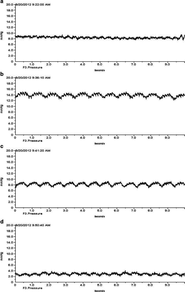 A sequence of four clinical intracranial pressure (ICP) waveforms (labeled a-d) recorded over 10-second intervals following a cryogenic brain injury model. The x-axis represents time in seconds, and the y-axis represents pressure in mmHg (0.0 to 20.0). Panel (a) shows a baseline ICP of approximately 8 mmHg with low-amplitude pulsatility before anesthesia. Panel (b) illustrates a transient spike in ICP to roughly 14 mmHg during anesthesia induction, characterized by increased waveform amplitude and distinct cardiac/respiratory rhythmic pulsations. Panel (c) shows the ICP returning toward the pre-anesthetic baseline of 8 mmHg as effects stabilize. Panel (d) demonstrates the pharmacological effect of AF-16 administration, showing a significant reduction in ICP to approximately 3 mmHg with dampened pulsatile variations. These recordings highlight the dynamic monitoring of intracranial hypertension and the subsequent therapeutic response to a neuroprotective peptide, illustrating changes in both absolute pressure levels and the morphology of pulsatile wave components.