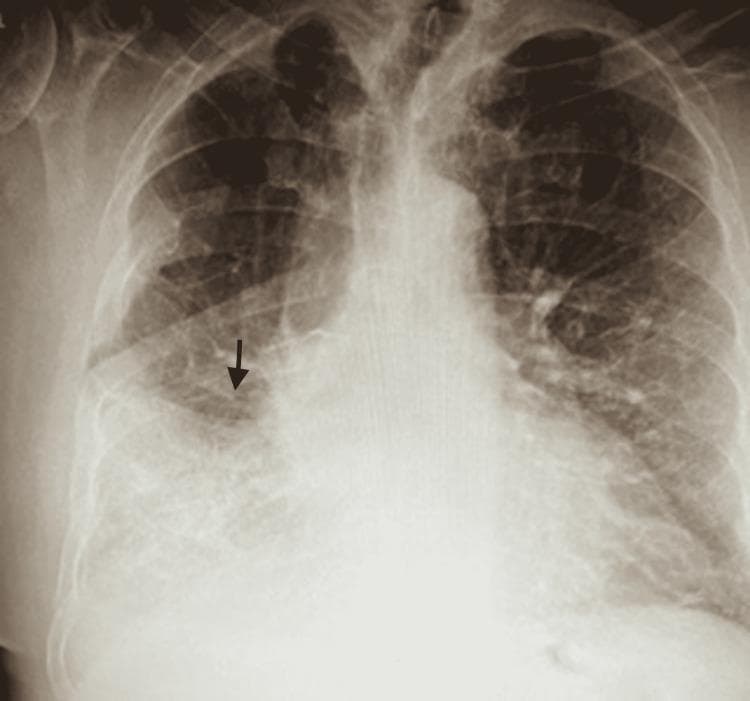 This diagnostic image is an anteroposterior (AP) chest X-ray demonstrating a significant area of increased opacity in the right mid-to-lower lung field. The opacity exhibits a patchy, heterogeneous texture and ill-defined borders, characteristic of an alveolar infiltrate or consolidation. A black arrow points to the superior margin of the infiltrate, which correlates clinically with consolidation in the right lower lobe. Visible air bronchograms within the dense area suggest the replacement of alveolar air with inflammatory fluid or exudate, common in community-acquired pneumonia (CAP). The left lung field remains relatively clear with normal vascular markings. This radiograph serves as a key educational example of lobar consolidation patterns in pulmonary infectious diseases, illustrating the radiographic hallmarks of bacterial pneumonia, such as Legionella or Streptococcus pneumoniae, and their manifestation as focal opacities on chest radiography.