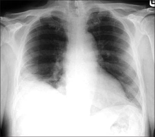 Hugging Face pmc clinical VQA raw