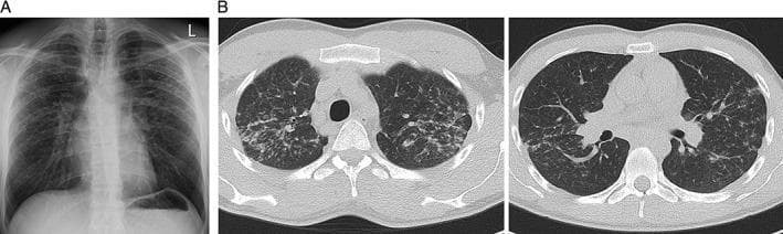 This diagnostic imaging set consists of a posteroanterior chest X-ray (A) and two axial high-resolution computed tomography (HRCT) slices (B) of the thorax, demonstrating characteristic findings of chronic interstitial lung disease. Panel A shows a projectional view of the chest with bilateral hazy opacities predominantly in the upper lobes, associated with a loss of lung volume suggestive of fibrotic changes. Panel B provides cross-sectional detail, revealing a diffuse reticulonodular pattern throughout the lung parenchyma. This is characterized by fine linear densities and small, ill-defined nodules, which are most concentrated in the upper lobes of both lungs. The CT scans also demonstrate signs of parenchymal architectural distortion and fibrosis. These radiological features are consistent with silicosis or other occupational pneumoconioses. The images are designed for medical education regarding thoracic radiology, specifically illustrating the transition from screening with conventional X-ray to the detailed characterization of interstitial patterns using HRCT.