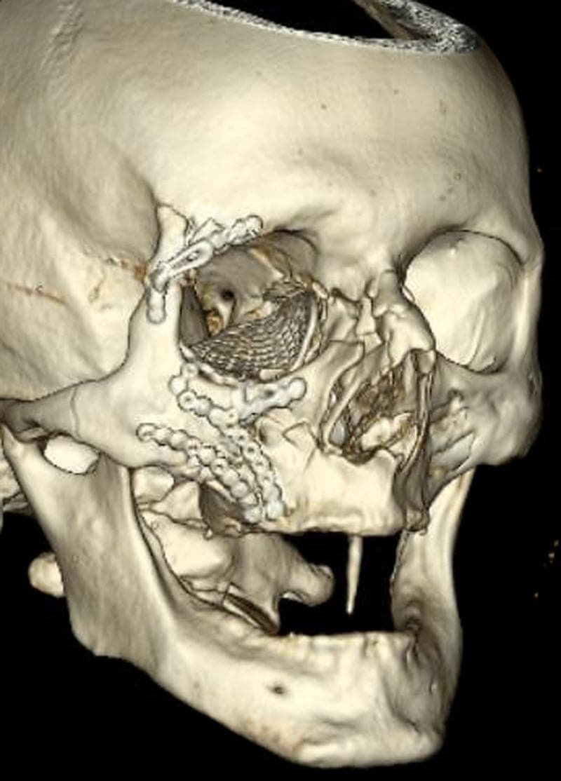 This diagnostic image is a three-dimensional (3D) computed tomography (CT) reconstruction of a human skull, specifically focusing on the right maxillofacial region. It demonstrates postoperative findings following open reduction and internal fixation (ORIF) for a complex zygomaticomaxillary complex (ZMC) fracture. Multiple titanium hardware components are visible: a mesh-like plate is positioned within the right orbital cavity for orbital floor/wall reconstruction, while several smaller osteosynthesis plates and screws bridge fractures at the zygomaticofrontal suture, the zygomatic arch, and the infraorbital rim extending toward the maxilla. The reconstruction highlights the surgical management of severe midface trauma, illustrating the anatomical realignment of the zygoma, orbit, and maxillary bones. The image serves as a high-level educational resource for oral and maxillofacial surgery, trauma radiology, and oculoplastics, showcasing complex facial fracture stabilization and orbital reconstruction techniques.