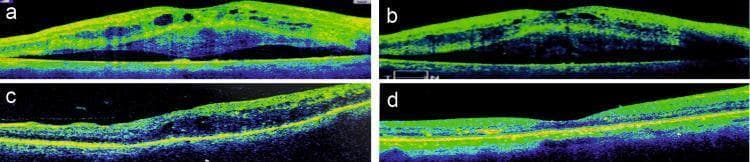 Diagnostic optical coherence tomography (OCT) scans demonstrating a comparison between pre-treatment and post-treatment states of bilateral macular edema. Images (a) and (b) represent the right and left eyes before treatment, showing significant diabetic macular edema (DME). Key pathological findings include intraretinal fluid with multiple cystoid spaces, diffuse retinal thickening, and a prominent paradoxical neurosensory detachment (NSD), visible as a dark hyporeflective space between the neurosensory retina and the retinal pigment epithelium (RPE). Images (c) and (d) show the same eyes one month after the administration of an intravitreal dexamethasone implant (Ozurdex). These follow-up scans demonstrate a successful therapeutic response characterized by the complete resolution of the subretinal fluid, closure of cystoid spaces, and significant reduction in central macular thickness (CMT). The neurosensory retina is shown to be fully reattached to the RPE with restoration of more normal foveal contour, illustrating the efficacy of corticosteroid implants in managing refractory or paradoxical macular edema.