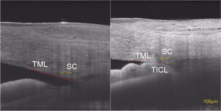 This diagnostic image consists of two side-by-side Swept-Source Optical Coherence Tomography (SS-OCT) B-scans of the human nasal iridocorneal angle. The images compare an open angle (left) with a closed angle demonstrating iridotrabecular contact (right). Key anatomical structures and measurements are annotated: Schlemm's canal (SC) is outlined with a yellow curve, showing a larger cross-sectional area in the open-angle image compared to the collapsed appearance in the closed-angle image. The trabecular meshwork length (TML) is marked by a red double-headed arrow extending from the scleral spur to Schwalbe's line. In the right image, the trabecular-iris contact length (TICL) is specifically highlighted with a blue double-headed arrow, quantifying the physical apposition between the iris and the trabecular meshwork. This comparison illustrates the morphological changes in SC parameters associated with primary angle-closure disease (PACD) and emphasizes how iridotrabecular contact correlates with reduced SC diameter and cross-sectional area, which is clinically relevant for understanding aqueous humor outflow obstruction.