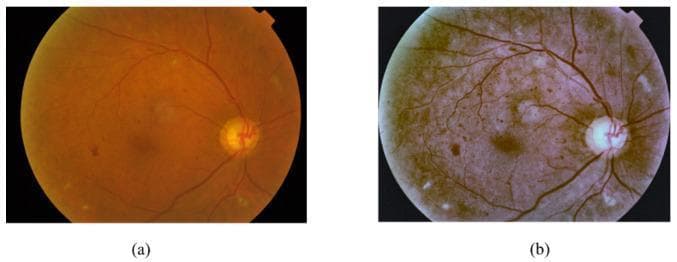 Diagnostic Image: Fundus Photographs. This figure shows two side-by-side retinal fundus images illustrating Diabetic Retinopathy (DR) manifestations and the effect of digital preprocessing. Image (a) is the original raw fundus photograph with a standard reddish-orange hue, showing the optic disc and retinal vasculature. Pathological findings include red lesions (microaneurysms and hemorrhages) appearing as dark spots, and bright lesions representing hard exudates (yellowish spots) and soft exudates/cotton wool spots (fluffy white areas). Image (b) shows the same retina after preprocessing to enhance contrast and sharpen clinical features. In the processed version, the overall tone shifts to a muted brownish-purple, making the vascular network more distinct and the lesions more defined. The preprocessing helps differentiate between red lesions and bright exudative lesions, which are critical for DR staging. This comparison demonstrates the role of image processing in improving the detectability of subtle retinal pathology for diagnostic AI models or clinical review.