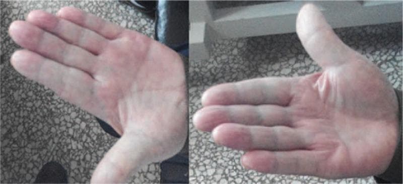 Clinical photograph showing two views of a patient's hands (palmar aspect) exhibiting the classic triphasic color changes associated with Raynaud's phenomenon. The image demonstrates a mottled appearance characterized by distinct zones of pallor (ischemic white), cyanosis (deoxygenated blue/purple), and reactive hyperemia (erythematous red). These vascular changes are most prominent across the digits and distal palmar surfaces. The skin texture appears intact without visible digital ulcers, gangrene, or sclerodactyly. In the clinical context of lung adenocarcinoma, these findings are representative of paraneoplastic Raynaud's phenomenon, a secondary form of the condition. This visual serves as an educational example of peripheral vasospastic disorders and their manifestations in systemic malignancy. The image highlights the importance of assessing hand coloration as a diagnostic indicator of underlying microvascular dysfunction.
