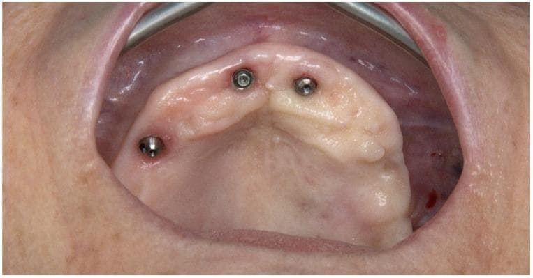 This intraoral photograph provides an occlusal view of a partially edentulous maxilla undergoing full-arch dental rehabilitation. The image depicts three integrated dental implants protruding through the gingival tissue. Two axial implants are positioned anteriorly in the region of the lateral incisors, while a third implant is located in the posterior right quadrant (anatomical left of the image), demonstrating a distal tilt consistent with an 'All-on-4' or hybrid protocol. The metallic, cylindrical implants show exposed screw access channels on their occlusal surfaces. The maxillary arch is U-shaped with a smooth, pale, and vascularized alveolar ridge. Notable findings include the absence of the posterior tilted implant in the third sextant (anatomical right), indicating a site of previous implant failure. The surrounding soft tissue appears healthy and well-adapted around the anterior implants, while the tissue surrounding the posterior tilted implant shows minor surgical irregularities. This clinical image is representative of restorative dentistry and oral surgery, illustrating pre-operative conditions for revision surgery in complex implant cases.
