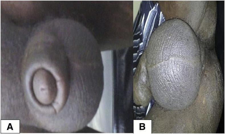 Two-panel clinical photograph (Figures 1A and 1B) illustrating atypical genital manifestations of visceral leishmaniasis in a patient with HIV coinfection. Panel A displays significant edema and swelling of the penile shaft. Panel B shows massive, diffuse scrotal swelling with a coarsely textured, thickened, and wrinkled skin surface. A focal nodular lesion is visible at the base of the scrotum. The visual findings represent cutaneous involvement in the context of systemic parasitic infection and immunodeficiency. This image serves as an educational reference for recognizing atypical extra-visceral presentations of Leishmania donovani infection, which may mimic other tropical or sexually transmitted diseases such as lymphogranuloma venereum. The presentation highlights the clinical significance of dermatological examination in HIV-positive patients living in or traveling from endemic regions (e.g., Ethiopia).