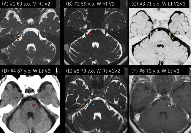 This composite diagnostic image displays radiological findings from six patients with trigeminal neuralgia, primarily using axial Magnetic Resonance Imaging (MRI) and Computed Tomography (CT) focusing on the posterior fossa and cerebellopontine angle (CPA). Panels A, B, and E demonstrate neurovascular compression (NVC) of the trigeminal nerve (yellow arrowheads). Specifically, panels A and E show compression by the petrosal vein (blue arrowheads), while panel B shows compression by the superior cerebellar artery (red arrowhead). Panel C illustrates a left trigeminal nerve without apparent vascular contact. Panel D provides a non-contrast CT view of the left cerebellopontine cistern (pink arrowheads) in a patient where MRI was contraindicated. Panel F displays a T1-weighted gadolinium-enhanced MRI showing a pathological mass/tumor (green arrowhead) within the left cerebellopontine cistern, representing secondary trigeminal neuralgia. The collection serves as an educational comparison between idiopathic, neurovascular, and secondary causes of trigeminal nerve dysfunction, highlighting the anatomical relationship between the nerve root entry zone and adjacent vascular or neoplastic structures.