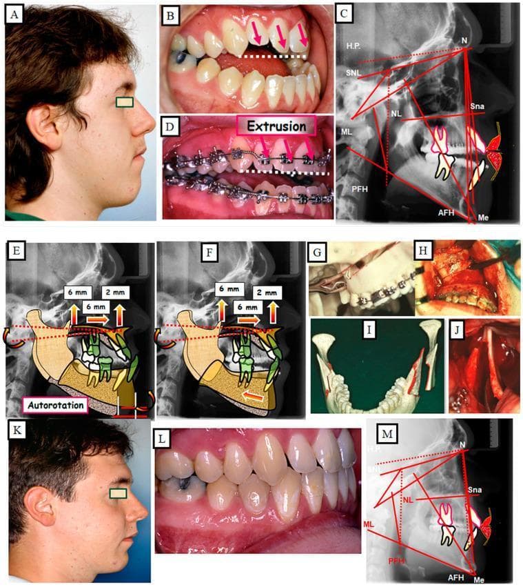 A multi-panel clinical educational figure documenting the surgical and orthodontic treatment of a 23-year-old male with a combined skeletal and dental anterior open bite. (A-C) Pre-treatment profile showing an elongated lower facial third, an intraoral view of severe anterior infraocclusion with red arrows indicating the vertical gap, and a lateral cephalogram with tracings (SNL, NL, ML) highlighting hyperdivergent jaw bases. (D) Pre-surgical orthodontic phase showing fixed appliances and the extrusion of anterior teeth. (E-F) Cephalometric surgical simulations demonstrating maxillary impaction (6mm) and resultant mandibular autorotation to close the vertical discrepancy and adjust the sagittal position. (G-J) Intraoperative photographs and 3D models illustrating the Le Fort I osteotomy for maxillary impaction and bilateral sagittal split osteotomy (BSSO) for mandibular adjustment with internal fixation. (K-M) Post-treatment results showing a reduced lower facial height, achieved dental occlusion with corrected overbite/overjet, and normalized cephalometric parameters. The content illustrates orthognathic surgical planning for long face syndrome and complex malocclusion.
