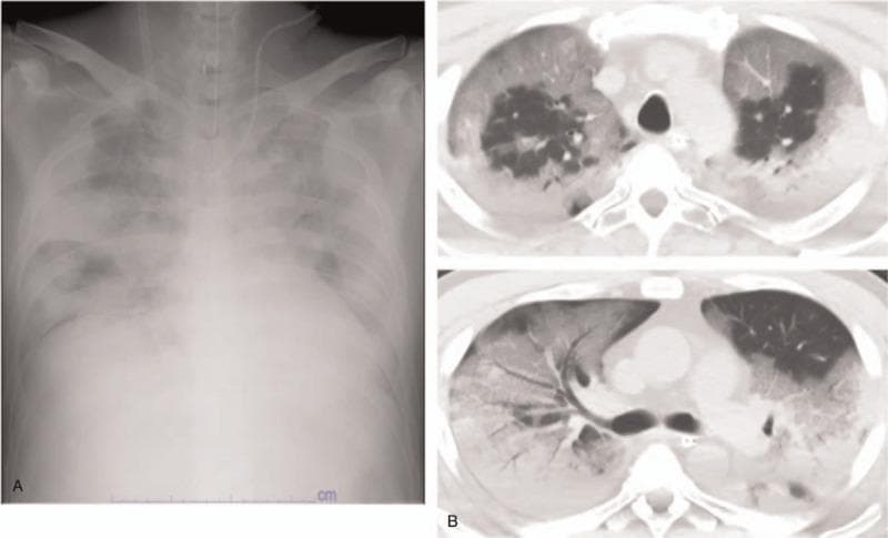 This composite diagnostic image displays imaging findings characteristic of Acute Respiratory Distress Syndrome (ARDS) in a patient with COVID-19 pneumonia. The left panel (A) is a front-view chest X-ray showing bilateral, diffuse alveolar infiltrates appearing as widespread hazy opacities across both lung fields. Notably, the cardiac silhouette appears normal in size, helping to differentiate this non-cardiogenic pulmonary edema from heart failure. The right panels (B) present two axial slices from a high-resolution computed tomography (HRCT) scan. These CT images demonstrate extensive, bilateral ground-glass opacities (GGOs)—areas of increased lung density where underlying bronchial and vascular structures remain visible. The distribution is peripheral and patchy, typical of viral pneumonitis progressing to ARDS. Clinical relevance includes the visual documentation of severe parenchymal lung disease requiring advanced respiratory support, such as mechanical ventilation or ECMO, as indicated by the presence of an endotracheal tube and monitoring lines in the X-ray.