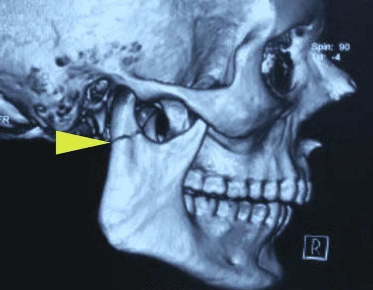 This diagnostic image is a 3D reconstruction from a computed tomography (CT) scan of a human skull, specifically showcasing the right lateral view of the mandible and maxillofacial region. A yellow arrow points to a distinct, sharp fracture line at the neck of the right mandibular condyle. The condylar fragment exhibits a slight deviation and anterior-medial displacement relative to the mandibular ramus and its normal articulation within the glenoid fossa. Key anatomical landmarks visible include the right zygomatic arch, the maxillary and mandibular dentition, and the mental protuberance. This visual illustrates a subcondylar fracture, a common injury in maxillofacial trauma that can result in malocclusion and altered mandibular kinetics. The image serves as an educational example of how 3D CT imaging is utilized to assess the degree of bony displacement and angulation in mandibular fractures to guide surgical or conservative management.