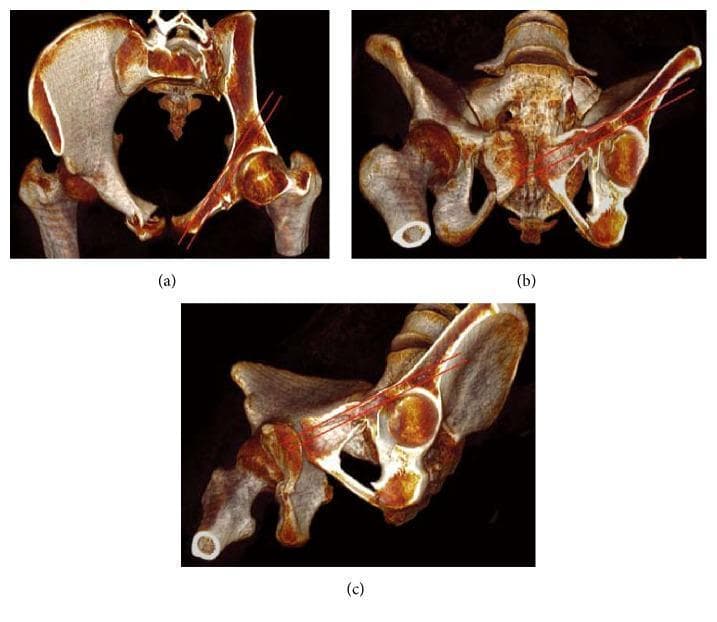 This medical illustration consists of three panels (a, b, and c) showing 3D-rendered diagnostic images of the human pelvis, used to demonstrate orthopedic surgical planning. The panels present different fluoroscopic-style views: (a) Pelvic inlet view, (b) Pelvic outlet view, and (c) Obturator outlet view. Each image features a volume-rendered model of the bony pelvis, including the ilium, ischium, pubis, and the proximal femur with the acetabulum. Overlaid on the right side of the pelvis are parallel red lines illustrating the 'osseous corridor' for an anterior column acetabular screw. The lines represent the precise intraosseous trajectory from the gluteus medius eminence above the acetabulum, extending through the superior pubic ramus toward the pubic tubercle. This diagram serves as an educational guide for surgeons to visualize screw placement for acetabular fracture fixation, highlighting the safe anatomical pathway to avoid cortical penetration or articular surface violation.