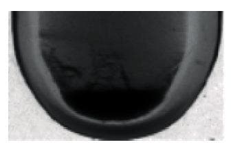 This diagnostic clinical image displays a close-up, grayscale view of the bottom portion of a laboratory test tube containing a liquid sample. The image illustrates a state of incomplete dissolution or insolubility, characterized by clear stratification of the contents. A distinct, highly opaque, and dark region is concentrated at the base of the tube, indicating the presence of a heavy precipitate or sedimented particulate matter. The upper portion of the liquid appears relatively lighter and less dense, though it remains non-homogeneous. This visual is used in medical laboratory science to teach the identification of insoluble samples, often in the context of hemolysis detection or serum/plasma quality assessment. The educational focus is on recognizing physical properties such as precipitation and density-based layering, which are critical for determining specimen integrity and the suitability of a sample for diagnostic testing.