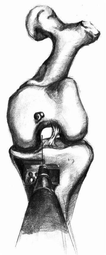 Anatomical diagram and surgical illustration of a knee joint during a Unicompartmental Knee Arthroplasty (UKA) procedure. The illustration features a sketch of the distal femur and proximal tibia. The femur is depicted with prominent condyles and a clear intercondylar notch. On the medial aspect of the proximal tibia, a surgical cutting block or tibial implant template is positioned, featuring visible screw holes for stabilization. A central surgical instrument, identified as an intramedullary rod inserter, is shown in the foreground. A thin intramedullary rod extends from the inserter, passing through the tibial component and projecting superiorly into the intercondylar notch of the femur. This setup demonstrates a modified surgical technique where the intramedullary rod serves as a directional guide to improve the accuracy of vertical bone cuts and implant positioning. The focus of the illustration is the spatial relationship between the surgical instrumentation and the knee anatomy to prevent malalignment during joint replacement.