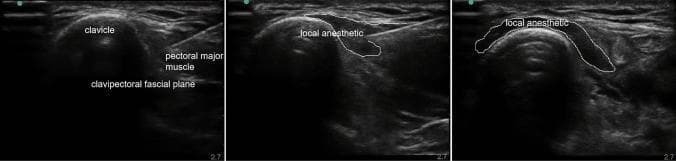 This composite of three diagnostic ultrasound images demonstrates the procedural technique for a Clavipectoral Fascial Plane Block (CPB). The primary anatomical landmark is the clavicle, visualized as a prominent, curvilinear hyperechoic structure with characteristic posterior acoustic shadowing. Overlying the clavicle is the pectoral major muscle, exhibiting a heterogeneous fibrillar echotexture. The clavipectoral fascia is identified as a hypoechoic interface located between the muscle and the clavicular periosteum. The series illustrates the sequential injection of local anesthetic, which appears as a dynamic, expanding hypoechoic (anechoic) fluid collection. The anesthetic is seen tracking along the clavipectoral fascial plane, effectively coating the anterior surface of the clavicle medially and laterally. This regional anesthesia technique is used for perioperative pain management in clavicular fractures or surgeries, targeting the sensory nerves that pass through this fascial space while avoiding deep structures like the pleura or brachial plexus.