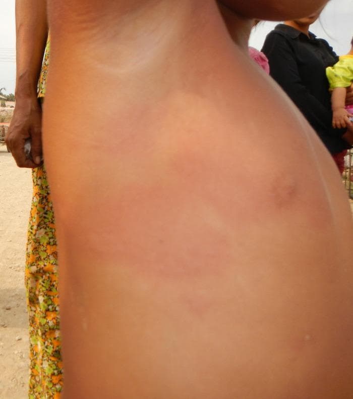 This clinical photograph shows the torso and upper arm of a child, illustrating generalized urticaria (hives). The skin exhibits diffuse erythema and inflammation, characterized by widespread red patches across the lateral chest and abdominal region. Several erythematous wheals and edematous plaques of varying sizes are visible, some of which demonstrate central pallor or darker red centers. The distribution is extensive and lacks a specific dermatomal pattern, consistent with a systemic allergic reaction or hypersensitivity response. The visual presentation focuses on the morphology of skin lesions, specifically the characteristic raised, red, and itchy appearance of acute urticaria in a pediatric patient. This image is relevant for dermatology and pediatrics, demonstrating post-vaccination cutaneous manifestations and the typical appearance of Type I hypersensitivity reactions.