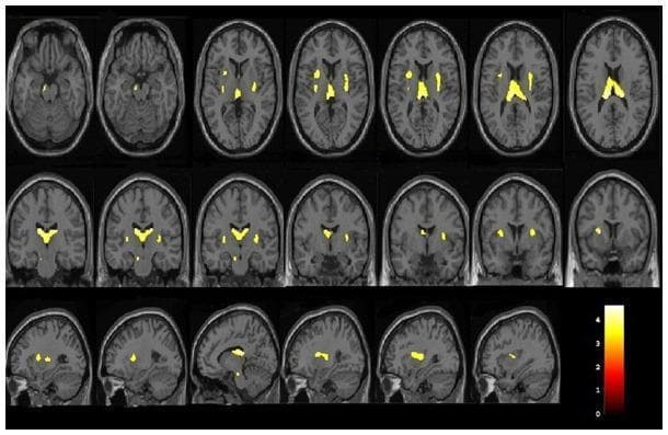This diagnostic image display consists of a series of brain MRI scans (T1-weighted templates) presented in axial, coronal, and sagittal planes, overlaid with Voxel-Based Morphometry (VBM) statistical results. The visualization highlights areas of significant grey matter volume reduction in patients with occult spastic diplegic cerebral palsy (SDCP) compared to healthy controls. Yellow-to-orange heat map clusters indicate localized volume loss. Key anatomical regions consistently showing involvement include the bilateral lentiform nuclei (putamen and globus pallidus), claustrum, thalamus, and insular cortex. A specific focus is also visible in the left cerebral peduncle. The axial slices (top row) demonstrate a symmetrical distribution in deep grey matter structures, while coronal (middle row) and sagittal (bottom row) views further define the vertical and lateral extent of these structural changes. A color-coded scale bar on the bottom right correlates intensity with statistical significance levels. This neuroimaging composite is used to study the neuroanatomical correlates of motor dysfunction in cerebral palsy patients.