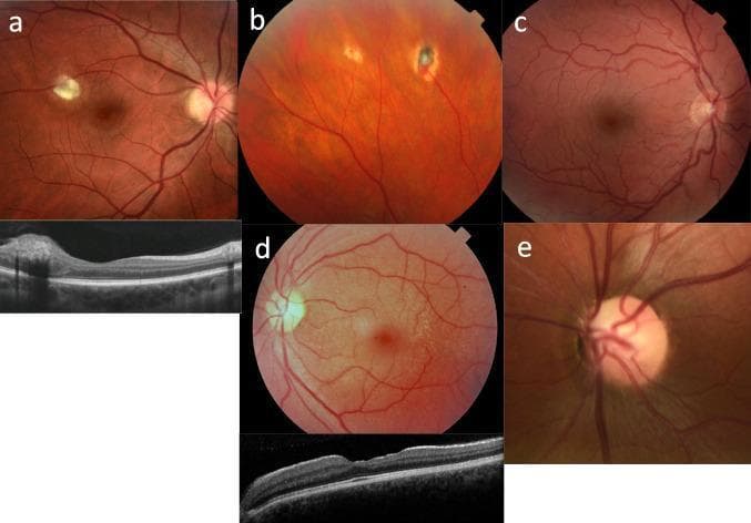 A composite medical visual containing five fundus photographs (a-e) and two Optical Coherence Tomography (OCT) scans, illustrating ocular manifestations of systemic diseases. (a) Fundus image of tuberous sclerosis featuring a semi-translucent, elevated white-yellow retinal astrocytoma near the optic disc, with a corresponding OCT showing an intraretinal mass. (b) Peripheral fundus view in von Hippel-Lindau syndrome showing atrophic, treated retinal hemangioblastomas. (c) Fundus photograph illustrating severe congenital vascular tortuosity of the retinal arteries and veins, typical of HANAC syndrome. (d) X-linked Alport syndrome presentation showing diffuse yellowish-white fleck retinopathy (fleck dystrophy) sparing the macula; the accompanying OCT demonstrates characteristic temporal retinal thinning and an altered foveal profile. (e) Close-up of the optic nerve head in renal coloboma syndrome, showing an excavated optic disc with retinal vessels emerging eccentrically from the disc periphery rather than the center. These images serve as educational resources for identifying ophthalmic markers in pediatric and adult renal ciliopathies.