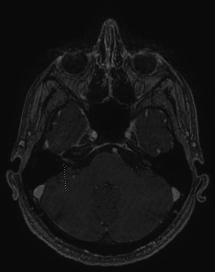 This diagnostic image is an axial T1-weighted post-contrast magnetic resonance imaging (MRI) scan of the brain at the level of the internal auditory canal. The scan provides a cross-sectional view of the posterior fossa and skull base, clearly delineating the cerebellum, temporal lobes, and sphenoid sinus. A prominent white dashed arrow indicates a focal pathological finding on the anatomical right side: asymmetric gadolinium enhancement of the facial nerve (Cranial Nerve VII) within the internal auditory canal and labyrinthine segment. This hyperintensity is notably absent in the corresponding contralateral (left) facial nerve, representing a significant diagnostic sign of neuritis. This radiological finding is clinically significant for the diagnosis of Bell's palsy (idiopathic facial nerve paralysis), demonstrating the inflammatory enhancement and edema typically associated with the condition. The image serves as a high-level educational resource for neurology and radiology students to identify cranial nerve pathology and understand the role of contrast-enhanced MRI in evaluating lower motor neuron facial nerve palsy.