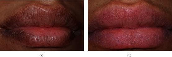 This clinical comparison photograph illustrates the outcome of laser lip depigmentation using an Er,Cr:YSGG laser system. Image (a) displays the baseline presentation, characterized by generalized hyperpigmentation of the upper and lower lips, resulting in a dark, brownish-black hue and an obscured vermillion border. The lip surface appears mildly textured with visible vertical rhytids and uneven pigment distribution. Image (b) shows the same patient 14 days following the final treatment session. There is a significant reduction in melanin density, transitioning the lip color to a more natural, uniform pinkish-red hue. The vermillion border is better defined, and the overall mucosal texture appears smoother and more hydrated. This educational visual demonstrates the efficacy of laser resurfacing for cosmetic oral melanin hyperpigmentation and the typical 14-day healing progression post-procedure.