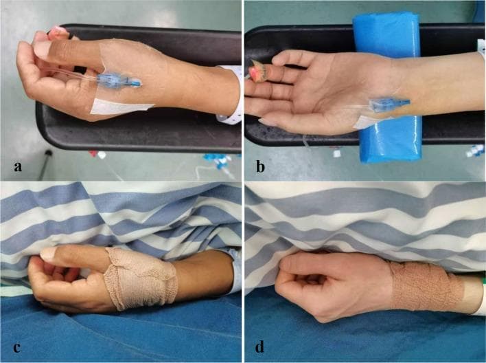 This composite clinical photograph illustrates two different sites for arterial catheterization and subsequent postoperative hemostasis. Panels (a) and (c) demonstrate the distal radial artery (dRA) approach. In panel (a), a 22-gauge catheter is inserted at the anatomical snuffbox on the dorsal side of the hand, secured with a transparent adhesive dressing and connected to a pressure transducer line. Panel (c) shows the same site post-removal, wrapped in an elastic compression bandage covering the snuffbox and base of the thumb for hemostasis. Panels (b) and (d) demonstrate the conventional forearm radial artery (RA) approach. Panel (b) shows the catheter inserted proximally to the radial styloid process on the volar aspect of the wrist, with the arm stabilized on a blue support. Panel (d) shows the corresponding post-procedure hemostasis using an elastic wrap around the wrist. The image serves as a clinical comparison between distal and proximal radial access points in anesthesiology and perioperative care, highlighting the distinct anatomical landmarks and bandaging techniques required for each.