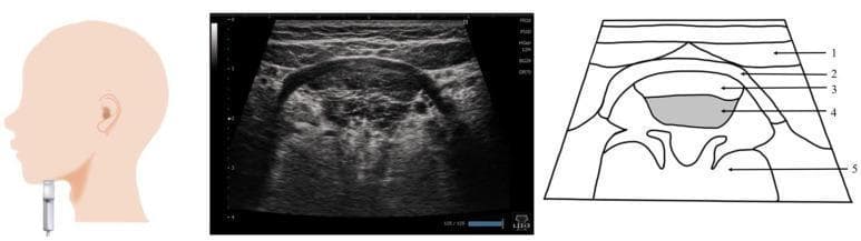 This composite educational graphic details the ultrasound anatomy of the submandibular region. It consists of three panels: a probe placement guide, a representative ultrasound image, and a labeled anatomical diagram. The leftmost panel shows a linear probe positioned vertically on the submandibular surface, perpendicular to the Frankfurt plane. The central ultrasound image displays a coronal cross-section of the suprahyoid musculature. The rightmost diagram provides structural identification: 1) Digastric muscle (superficial), 2) Mylohyoid muscle, 3) Geniohyoid muscle, 4) Genioglossus muscle (deep, shaded grey), and 5) The body of the tongue. The muscles are visualized in a layered, hierarchical arrangement from superficial to deep. Key visual markers include the hyperechoic fascia lines separating the muscle groups. This imaging technique is clinically relevant for assessing tongue thickness, swallowing disorders (dysphagia), and the cross-sectional area of floor-of-mouth musculature in geriatric or rehabilitation medicine.