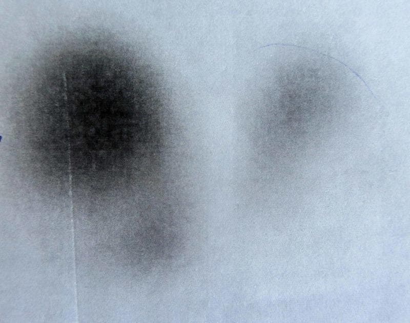 This diagnostic image is a thyroid scintigraphy (nuclear scan) demonstrating radioactive isotope uptake in the thyroid gland. The scan reveals two distinct areas of tracer accumulation against a light background. On the anatomical right side, there is a large, intensely dark, and well-defined focal area of increased tracer uptake, characteristic of an autonomous hyperfunctioning 'hot' nodule or toxic adenoma. The anatomical left side shows a much smaller, faint, and poorly defined region of tracer uptake, suggesting suppression of the surrounding normal thyroid tissue due to the activity of the hyperfunctioning nodule. This visual finding is typical of Marine-Lenhart syndrome or a solitary toxic adenoma where the high hormonal output from the 'hot' nodule inhibits TSH secretion, resulting in reduced activity in the contralateral lobe. The image serves as an educational tool for identifying thyroid hyperactivity patterns and differentiating between focal and diffuse thyroid pathology in nuclear medicine.