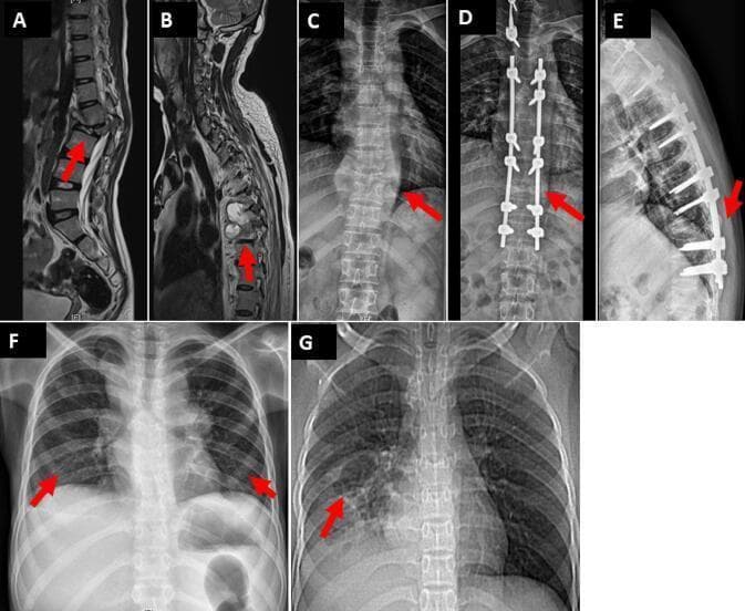This composite figure displays diagnostic imaging of skeletal and pulmonary tuberculosis (Pott's disease). Images A-E showcase spinal involvement: (A) Sagittal T2-weighted MRI of the lumbar spine reveals L2 vertebral destruction with associated psoas and paravertebral collections. (B) Sagittal T2-weighted MRI of the thoracic spine shows destruction of T6-T7 with epidural and subligamentous extension. (C) Anteroposterior (AP) radiograph demonstrates a large paravertebral abscess at T10. (D) AP and (E) lateral radiographs show post-operative posterior stabilization using pedicle screws and rods for spinal decompression. Images F and G illustrate pulmonary manifestations: (F) An AP chest X-ray shows diffuse bilateral nodular consolidations, consistent with miliary or disseminated tuberculosis. (G) A thoracic CT scout or radiograph indicates localized consolidation with cystic changes and branching 'tree-in-bud' nodular opacities in the right lower lobe. The collection serves as an educational tool for identifying various stages and modalities used in diagnosing and treating disseminated Mycobacterium tuberculosis infections in pediatric and adult populations.