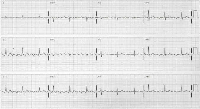A 12-lead electrocardiogram (ECG) demonstrating typical counterclockwise atrial flutter. The primary diagnostic feature is the presence of continuous 'F' waves, exhibiting a classic 'sawtooth' pattern. These flutter waves are most prominent in the inferior leads (II, III, and aVF), where they show negative polarity with a slow downward slope and a rapid upward deflection. In lead V1, the 'F' waves are upright (positive). There is a characteristic absence of an isoelectric line between the atrial deflections. The ventricular rate is regular, consistent with a fixed conduction ratio (e.g., 2:1 or 3:1). This rhythm reflects a macroreentrant atrial circuit typically involving the cavotricuspid isthmus (CTI). The ECG provides a clear educational example of atrial tachyarrhythmia classification, distinguishing typical counterclockwise flutter from clockwise variants based on lead-specific wave polarity.