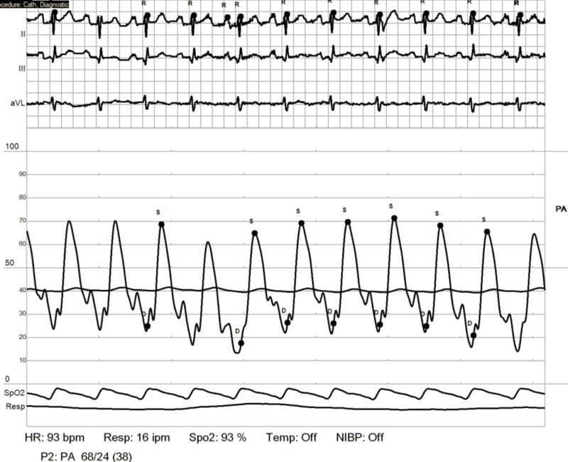 A multi-parameter medical monitor display from a right heart catheterization (RHC) procedure. The primary visual focus is a pulmonary artery (PA) pressure waveform tracing, which demonstrates significantly elevated pressures. The PA waveform shows cyclical systolic peaks (labeled 'S') and diastolic troughs (labeled 'D'), with a numerical measurement of 68/24 (38) mmHg, indicating pulmonary hypertension. Positioned above the PA tracing are three electrocardiogram (ECG) leads (II, III, and aVL) showing a sinus rhythm at a heart rate (HR) of 93 beats per minute. Below the pressure tracing are continuous waveforms for pulse oximetry (SpO2) and respiration (Resp). Numerical data at the bottom of the screen confirm a heart rate of 93 bpm, a respiratory rate of 16 inspirations per minute, and an oxygen saturation level of 93%. This clinical image illustrates hemodynamic monitoring in a patient with systemic sclerosis-associated pulmonary arterial hypertension (SSc-PAH) following medical management.