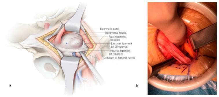 This composite visual contains an anatomical illustration (a) and a corresponding clinical intraoperative photograph (b) detailing the surgical repair of a femoral hernia.
Panel (a) provides a labeled anatomical diagram of the right inguinal-femoral region. It depicts the spermatic cord and falx inguinalis retracted cranially, exposing the orificium of the femoral hernia. Key landmarks are identified: the transversalis fascia (opened), the inguinal ligament of Poupart (ventral border), and the lacunar ligament of Gimbernat (medial border). An instrument is shown passing through the femoral orifice to demonstrate the pathology.
Panel (b) is a clinical photograph of the surgical field during an open repair. It demonstrates the clinical application of the anatomy shown in panel (a), with retractors maintaining exposure. A surgical instrument is seen incising the lacunar ligament to enlarge the femoral space for mesh placement. The image illustrates the relationship between the inguinal ligament, femoral vessels, and the hernia orifice.
The content is intended for intermediate to advanced surgical education, specifically regarding open femoral hernia repair and the anatomy of the femoral canal.