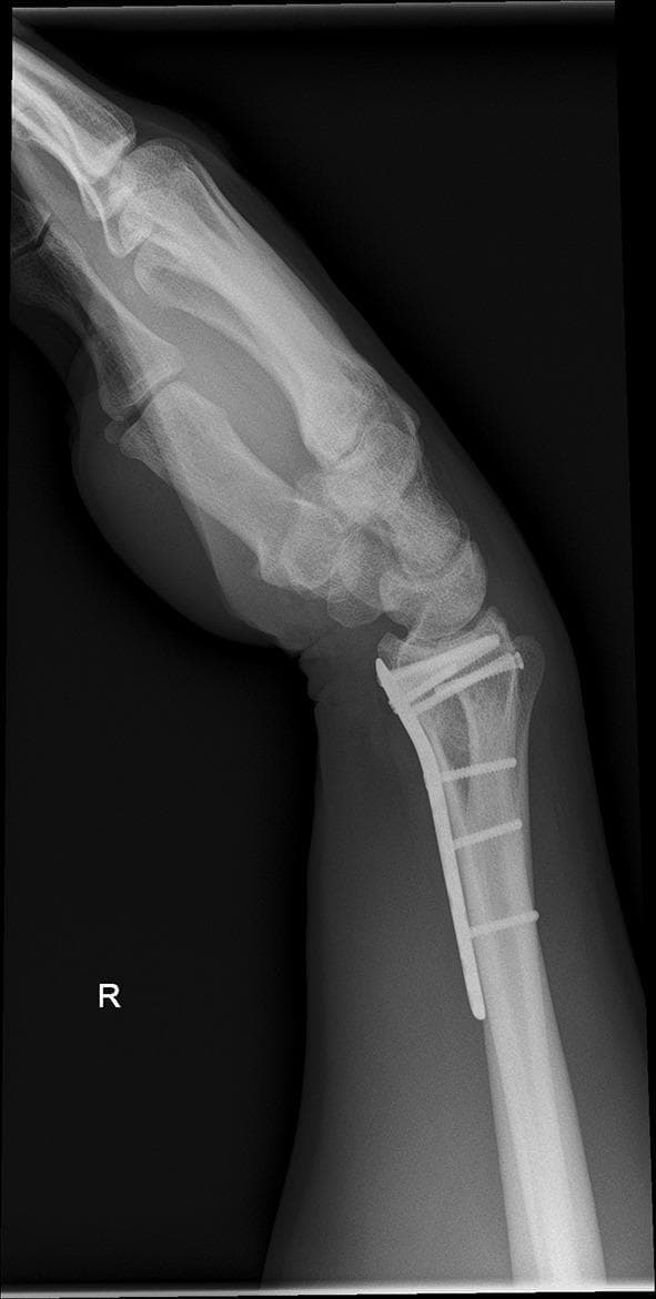 This diagnostic X-ray illustrates a lateral view of a right wrist in a flexed position, serving as an assessment of range of motion prior to hardware removal. The radiograph displays a distal radius fracture previously managed with open reduction and internal fixation (ORIF). A volar locking plate is visible, secured to the distal radial metaphysis and shaft with multiple screws. The distal screws are positioned in a subchondral fashion to support the articular surface. Anatomical structures clearly visualized include the distal radius, distal ulna, carpal bones (including the scaphoid and lunate), and the bases of the metacarpals. The image evaluates the relationship between the hardware and the carpal alignment during joint movement, highlighting potential mechanical impingement or soft tissue restrictions, such as the palmar and dorsal scar formation mentioned in the clinical context. This imaging is characteristic of orthopedic follow-up for complex intra-articular fractures.