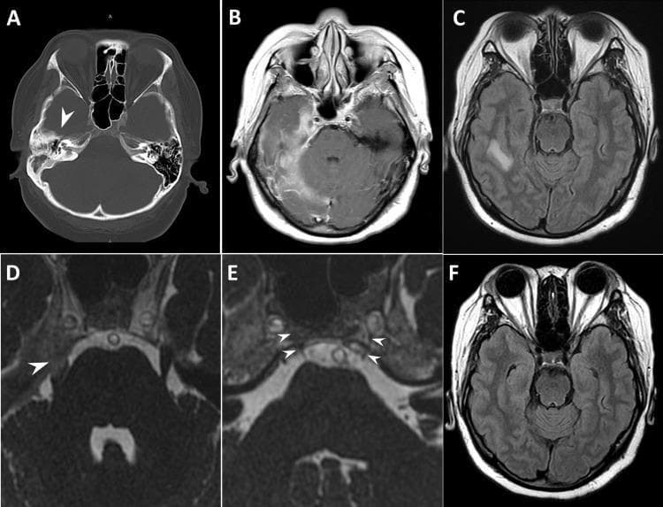 This composite figure displays diagnostic imaging of a patient with Gradenigo’s syndrome, emphasizing complications of chronic otitis media. Panel A is an axial non-contrast CT scan of the head showing decreased pneumatization of the right mastoid air cells and opacification of the petrous apex (arrowhead), indicative of petrous apicitis. Panels B and C are axial MRI slices (Post-contrast T1-weighted and FLAIR, respectively) demonstrating right-sided pachymeningitis, leptomeningitis, and hyperintense signal in the temporal lobe representing cerebritis. Panel D focuses on the right Meckel’s cave, showing inflammatory enhancement involving the trigeminal nerve (arrowhead). Panel E provides a detailed view of the Dorello canal, highlighting inflammatory swelling (arrowheads) which correlates with abducens nerve palsy. Panel F shows a follow-up axial MRI demonstrating complete resolution of the right temporal lobe cerebritis. This series illustrates the classic clinical triad of Gradenigo’s syndrome: otorrhoea, retro-orbital pain (trigeminal nerve involvement), and abducens nerve palsy, linked to apical petrositis.