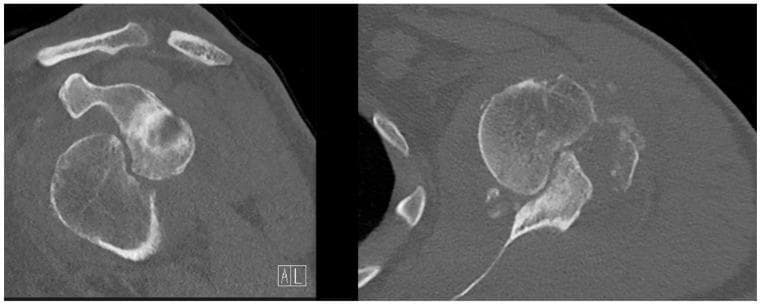 This diagnostic imaging set consists of two preoperative Computed Tomography (CT) scans of a human shoulder, presented in coronal (left) and transversal (right) views. The images demonstrate significant orthopedic pathology following an anterior glenohumeral dislocation. The transversal view clearly shows a large Hill-Sachs deformity, characterized by a substantial, irregular cortical depression or compression fracture on the posterolateral aspect of the humeral head. In the coronal view, a bony Bankart lesion is evident as a cortical discontinuity and bone loss at the anterior-inferior glenoid rim. These combined findings represent bipolar bone loss, which is clinically significant for determining shoulder stability and surgical planning. The CT highlights the morphological changes in the glenohumeral joint, providing essential detail for classifying the lesions as 'off-track' and assessing the need for procedures like a Latarjet or Remplissage.