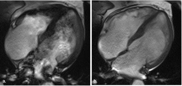 This Comparison Chart displays two diagnostic images (a and b) from a Cardiac Magnetic Resonance (CMR) study. Both images show a four-chamber view of the heart using a Steady-State Free Precession (SSFP) cine sequence. The comparison illustrates the impact of 'off-resonance artifacts,' which are common in high-field strength MRI (3.0T). Image (a) demonstrates significant signal distortion and heterogeneity within the left and right ventricles and atria, resulting in blurred endocardial borders and obscured valvular anatomy. Image (b) shows the result of frequency offset adjustment (+50Hz), which effectively minimizes the off-resonance artifact. This technical correction restores signal uniformity and enhances the clarity of anatomical structures, including the interventricular septum, atrial walls, and ventricular chambers. The educational focus is on MRI physics and artifact management, specifically teaching how to optimize SSFP sequences for clearer diagnostic imaging of cardiac morphology and function.