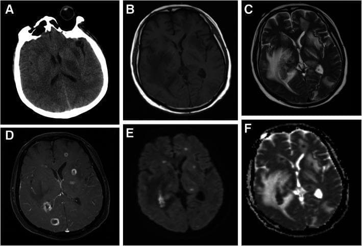 This composite of diagnostic neuroimaging displays a brain abscess case through CT and MRI modalities. Image (A) is a non-contrast axial CT scan showing multiple ill-defined low-density shadows within the brain parenchyma. Images (B-F) provide more detailed MRI sequences: (B) T1-weighted image showing hypointense irregular lesions; (C) T2-weighted image demonstrating significant hyperintense vasogenic edema and local mass effect in the right temporal lobe and bilateral basal ganglia; (D) Post-contrast T1-weighted image showing characteristic smooth ring enhancement of the abscess capsules; (E) Diffusion-weighted imaging (DWI) and (F) Apparent Diffusion Coefficient (ADC) map, which are used to evaluate restricted diffusion typical of pyogenic abscesses. The lesions are localized primarily in the right temporal lobe and bilateral basal ganglia. This series illustrates the typical progression from simple low-density findings on CT to the definitive ring-enhancing morphology and surrounding edema on multi-parametric MRI, essential for differentiating abscesses from neoplastic or inflammatory processes.