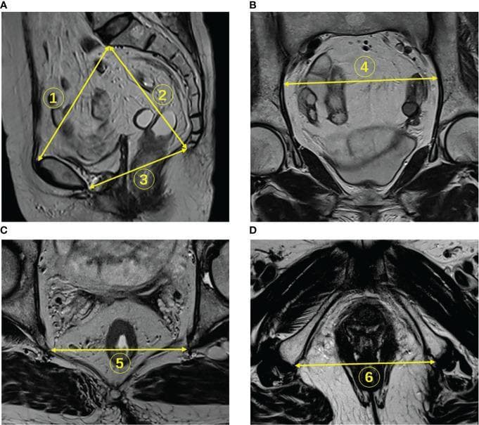 A composite of four T2-weighted magnetic resonance images (MRI) of the human pelvis, demonstrating standardized pelvimetry measurements used for obstetric or surgical assessment. (A) Sagittal section showing three anteroposterior diameters: line 1 (pelvic inlet) from the sacral promontory to the superior pubic symphysis; line 2 (pelvic depth) from the promontory to the tailbone; and line 3 (pelvic outlet) from the inferior pubic symphysis to the tailbone. (B) Coronal section showing line 4, representing the transverse diameter between the iliopectineal lines. (C) Axial section at the level of the mid-pelvis showing line 5, the interspinous distance between the ischial spines. (D) Lower axial section showing line 6, the intertuberous distance between the ischial tuberosities. These diagnostic images utilize the high contrast between low-signal (dark) cortical bone and surrounding soft tissues to define key anatomical landmarks. This material serves as an educational reference for radiological pelvimetry and pelvic anatomy classification.