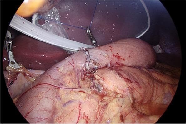 This laparoscopic clinical photograph illustrates a Billroth I reconstruction featuring a delta-shaped anastomosis. The image shows the surgical joining of the remnant stomach and the duodenum following a partial gastrectomy. The anastomosis site is centrally located, characterized by a visible line of interrupted blue sutures and metallic surgical clips that approximate the pink, vascularized tissue edges. To the left, a metallic surgical grasper is seen manipulating the tissue, while a white stabilization device or retractor is positioned superiorly. The surrounding anatomy includes the liver (dark red/brown organ) and omental fat. This image demonstrates the intraoperative appearance of a functional gastrointestinal anastomosis, focusing on tissue viability, suturing technique, and the use of mechanical stapling/clipping devices in oncological gastric surgery.