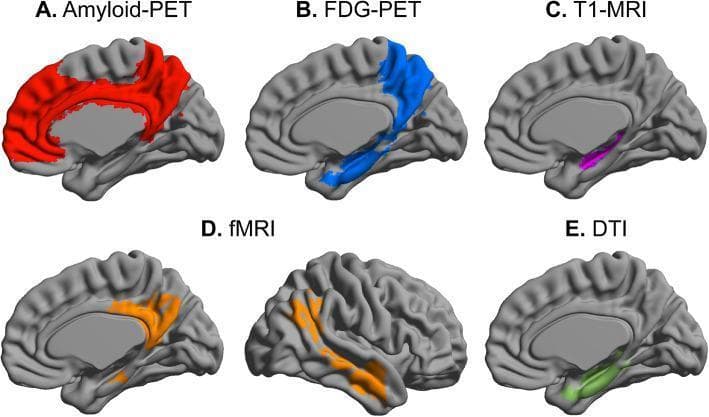 This infographic presents a multimodal imaging signature of Subjective Cognitive Decline (SCD) in the context of Alzheimer's disease progression. It displays five distinct neuroimaging modalities mapped onto a sagittal brain template. (A) Amyloid-PET highlights amyloid accumulation in red within the medial prefrontal cortex, cingulate cortex, and precuneus. (B) FDG-PET illustrates hypometabolism in blue, primarily affecting the medial temporal lobe and precuneus. (C) T1-MRI identifies structural changes in purple, specifically reduced volume in the hippocampus and thinning of the entorhinal cortex. (D) fMRI depicts abnormal functional connectivity in orange, focusing on the posterior Default Mode Network (DMN) and related cortical regions. (E) Diffusion Tensor Imaging (DTI) shows decreased fractional anisotropy (FA) in green, indicating white matter microstructural deficits in the hippocampal and parahippocampal areas. This comparative visual serves as a summary of molecular, structural, and functional biomarkers used to identify early neuroanatomical vulnerability in preclinical stages of dementia.