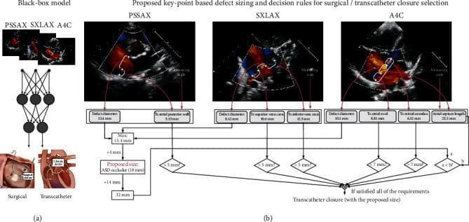 Educational diagram illustrating two artificial intelligence frameworks for Atrial Septal Defect (ASD) treatment planning. (a) A 'Black-box model' uses a neural network to map multiview Doppler transthoracic echocardiogram (TTE) images (PSSAX, SXLAX, A4C) directly to binary treatment options: surgical or transcatheter closure. (b) The 'Deep Keypoint Stadiometry' (DKS) model employs an interpretable algorithmic approach. It extracts clinical measurements from three echocardiographic views: Parasternal Short Axis (PSSAX) for defect diameter and atrial posterior wall distance; Subxiphoid Long Axis (SXLAX) for defect diameter and superior/inferior vena cava distances; and Apical Four-Chamber (A4C) for defect diameter, atrial roof, atrial annulus, and septum length. These anatomical measurements feed into a Boolean decision logic using clinical thresholds (e.g., >5mm, >7mm). If all criteria are satisfied, the model recommends transcatheter closure and calculates the proposed ASD occluder size based on the maximum defect diameter plus a 4mm margin. The diagram highlights the transition from opaque deep learning to interpretable, expert-knowledge-based clinical decision support.