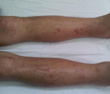 Clinical photograph of the bilateral lower limbs (shins and ankles) demonstrating prominent dermatological and systemic manifestations. The image shows significant generalized edema (oedema), characterized by increased limb girth and puffiness. Multiple cutaneous hemorrhagic lesions are visible across the anterior and lateral surfaces of both legs. These include numerous pinpoint, non-blanching red-to-purple spots consistent with petechiae, as well as larger, irregular, confluent patches of reddish-purple discoloration indicative of ecchymosis. The distribution is diffuse, extending from the ankles to the mid-calf. These clinical signs suggest vascular fragility, a coagulopathy, or systemic congestion, often associated with infectious processes such as CMV myocarditis or cardiac insufficiency. The visual evidence of petechiae and ecchymosis indicates intradermal and subcutaneous bleeding, while the limb swelling is consistent with high-grade pitting edema (++++/4+).