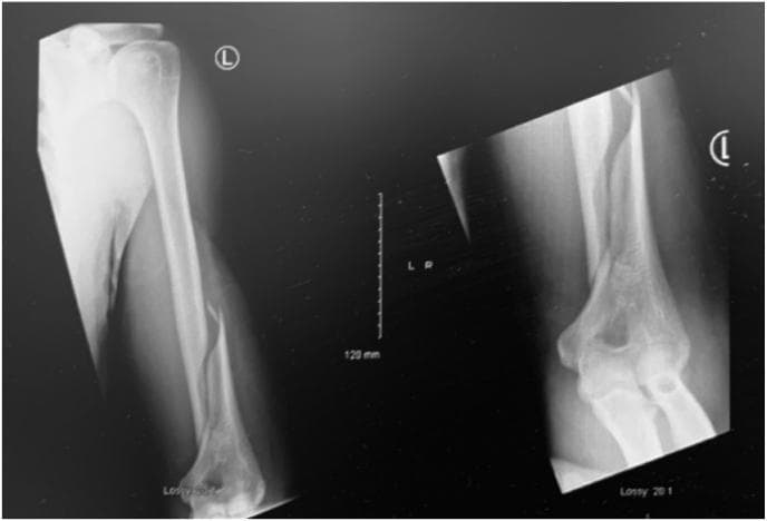 This diagnostic image consists of two radiographic views of the left upper extremity, specifically targeting the humerus. The x-rays reveal a displaced fracture of the distal third of the humeral shaft, identified as a Holstein-Lewis fracture (AO/OTA classification 12A1.3). The fracture pattern is primarily spiral or long oblique with significant lateral displacement and angulation of the distal fragment. Visible soft tissue swelling is noted adjacent to the injury site. The proximal humerus and the elbow joint, including the articulation of the distal humerus with the radius and ulna, appear otherwise intact with preserved joint spaces. A clinical marker 'L' denotes the left side. This case is highly relevant for orthopaedic education, illustrating a classic mechanism-of-injury fracture (torsional force from arm wrestling) that carries a high clinical association with radial nerve neuropraxia due to the proximity of the nerve to the spiral groove in the distal third of the humerus.