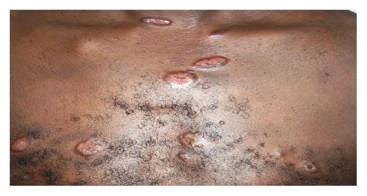This clinical photograph shows multiple skin lesions on the chest of a dark-skinned patient, consistent with cutaneous sarcoidosis. The primary lesions are well-circumscribed, raised papules and small nodules ranging in color from reddish-pink to brownish-copper. Notable morphological features include central umbilication and crusting in several lesions, suggesting a degree of ulceration or regression. The distribution is scattered across the upper chest, including the infraclavicular and sternal regions. Individual lesions vary in shape from circular to elongated, with surface textures appearing rough or irregular compared to the surrounding healthy skin. These findings are characteristic of the elementary skin lesions found in systemic sarcoidosis, often representing granulomatous infiltration of the dermis. The image serves as an educational example of how systemic inflammatory diseases present dermatologically in patients with higher melanin levels.