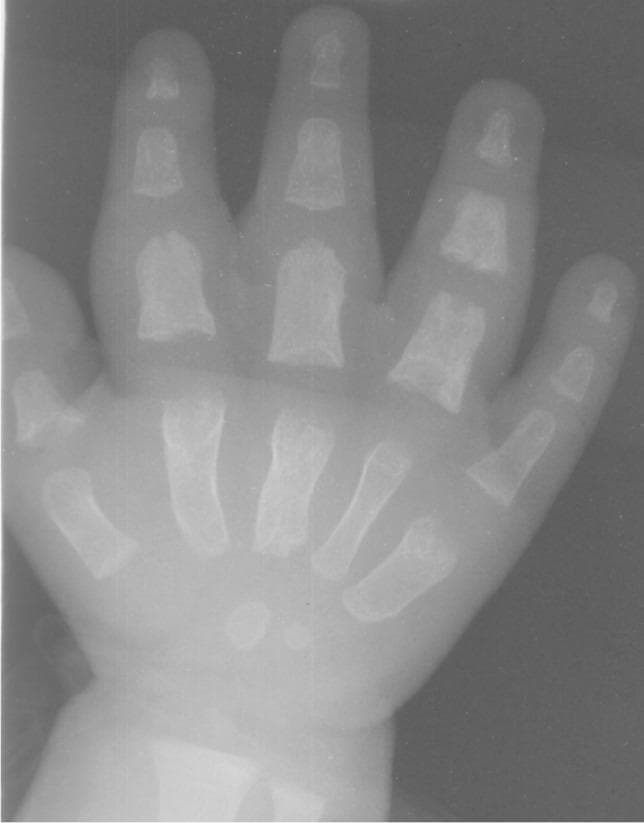 This dorsopalmar radiograph of a pediatric hand (infant) demonstrates classic radiographic findings of tuberculous dactylitis, also known as spina ventosa. The imaging reveals characteristic fusiform expansion of multiple short tubular bones. Specifically, there is prominent spindle-like widening of the second, third, and fifth metacarpals. Similar fusiform swelling and cortical erosion are evident in the first, second, third, and fourth proximal phalanges, as well as the fourth middle phalanx. The bones show rarefaction of the medulla with a thin, expanded cortex and overlying soft tissue swelling, particularly notable in the second through fourth digits. These findings represent the rapid destruction of the marrow space by granulomatous tissue, resulting in internal cyst-like cavities and bone expansion. The lack of significant periosteal reaction and the presence of both expansion and erosion in a young child are highly suggestive of a tuberculous etiology rather than pyogenic osteomyelitis.