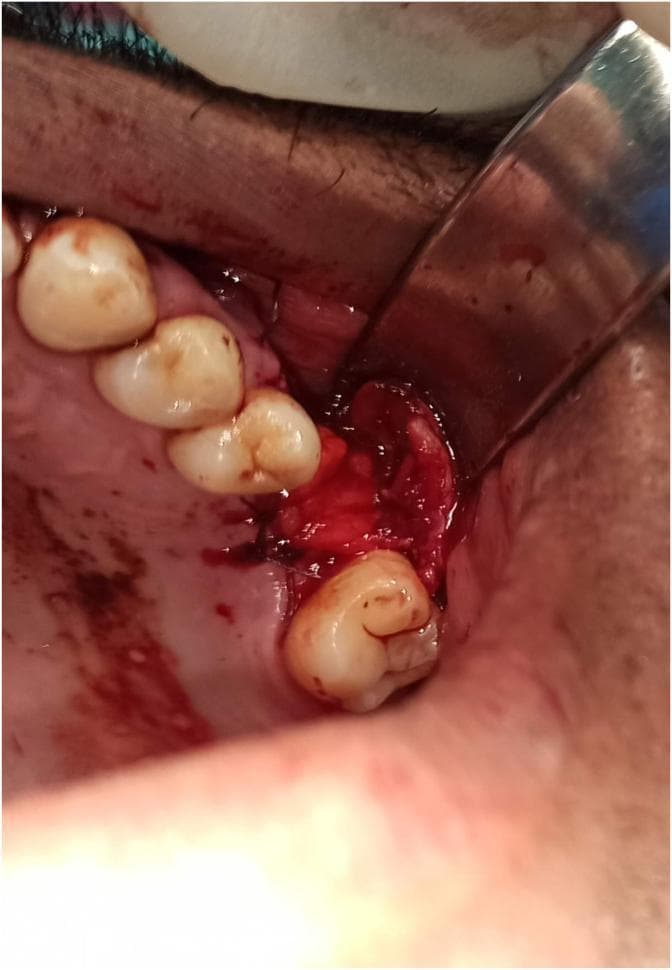 This clinical intraoral photograph demonstrates an oral surgery procedure for the closure of an oro-antral fistula (OAF) or communication. The image shows the mobilization and traction of the buccal fat pad (BFP) into a posterior maxillary alveolar bone defect. A metal surgical retractor reflects the buccal mucosa to expose the surgical field. The BFP, characterized by its yellowish-red lobular adipose appearance, is positioned to act as a vascularized pedicled flap over the defect. Simple interrupted sutures using a dark monofilament material are visible, securing the adipose tissue to the surrounding palatal and gingival margins. The surgical site includes several visible maxillary teeth with some blood contamination typical of an active procedure. This image illustrates a common reconstructive technique in oral and maxillofacial surgery where the anatomical proximity of the BFP is leveraged to provide a primary hermetic seal for sinus communications, facilitating secondary intention healing or supporting a subsequent mucoperiosteal flap closure.