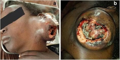 Clinical photograph of a patient with a giant, disfiguring cervicofacial mass (Panel A) and a detailed view of its ulcerated surface (Panel B). The lesion is located on the left cervical region, extending from the infra-auricular area down the neck. Panel A illustrates the mass's significant size and expansive growth, which distorts the normal facial contours. The skin surrounding the lesion appears indurated and irregular. Panel B shows a large, central ulceration with irregular, erythematous, and inflamed borders. The base of the ulcer contains yellowish purulent exudate and granular, necrotic-appearing tissue. This presentation is characteristic of advanced cervicofacial actinomycosis, an indolent bacterial infection that typically presents with 'lumpy jaw' features, abscess formation, and draining sinus tracts that may contain characteristic sulfur granules. The image demonstrates the severe tissue destruction and chronic inflammatory response associated with untreated or late-stage anaerobic infections of the head and neck.