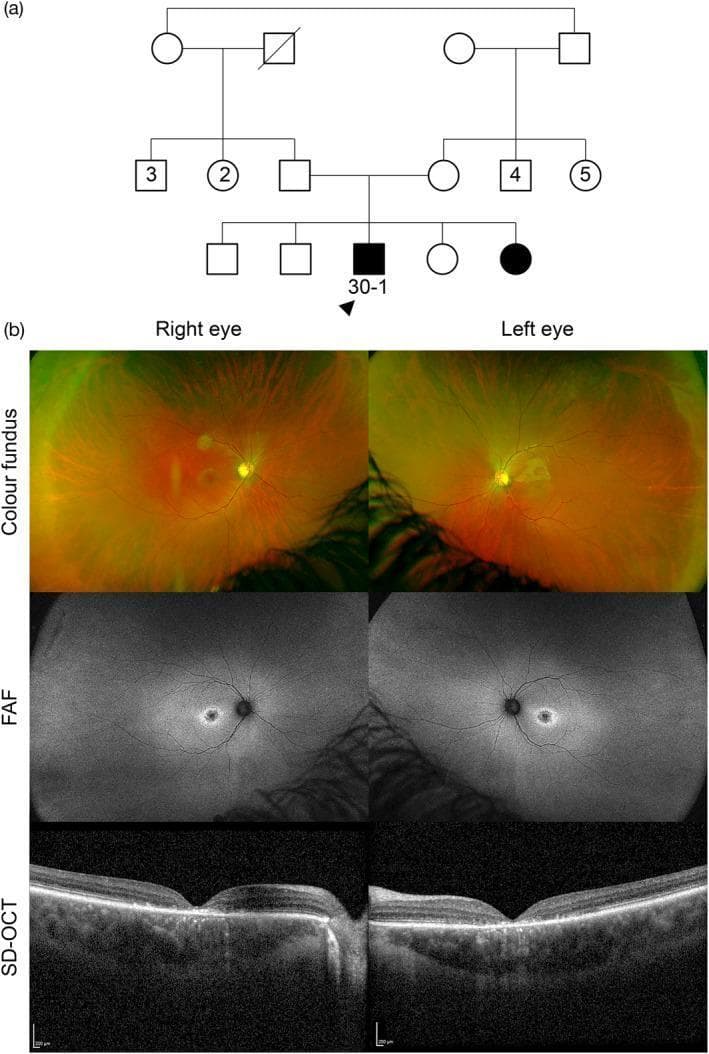 This composite educational graphic details the clinical and genetic profile of a patient with ABCA4-associated retinopathy, specifically Stargardt disease. Section (a) shows a pedigree diagram indicating autosomal recessive inheritance with parental consanguinity. Section (b) presents bilateral ophthalmic imaging: Ultra-widefield (UWF) color fundus photographs demonstrate well-circumscribed areas of central macular atrophy accompanied by scattered pisciform yellow macular flecks. Fundus Autofluorescence (FAF) images exhibit corresponding central hypoautofluorescence (representing retinal pigment epithelium loss) surrounded by a ring of hyperautofluorescence where the active yellow flecks are located. Spectral-domain optical coherence tomography (SD-OCT) horizontal line scans through the foveola reveal significant attenuation of the outer retinal layers, specifically the loss of the ellipsoid zone and thinning of the outer nuclear layer. The multimodal findings characterize the typical phenotype of Stargardt disease, including geographic atrophy and fleck accumulation, correlating with biallelic variants in the ABCA4 gene.