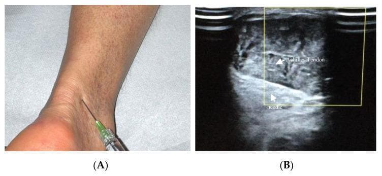 This composite educational figure illustrates the clinical and ultrasonographic aspects of a hyaluronic acid (HA) injection for Achilles tendinopathy. Panel A is a clinical photograph showing a dorsolateral approach to the Achilles tendon in the lower ankle region. A syringe with a 22-gauge needle and a green hub is shown at the entry point, demonstrating the trajectory required to reach the peritendinous space or mesotendon. Panel B is a corresponding ultrasound image (5–12 MHz linear probe) in the transverse plane. It depicts the internal anatomy of the Achilles tendon, which appears as a heterogeneous, ellipsoidal structure. Within the ultrasound's yellow focus box, the 22-gauge needle is clearly visible as a hyperechoic linear structure inserted at a 30-degree angle. Labels identify both the 'Achilles Tendon' and the 'needle' within the mesotendon. This content is designed for orthopedics and sports medicine education, demonstrating precise needle placement for viscosupplementation or regenerative therapy while avoiding intratendinous injection.