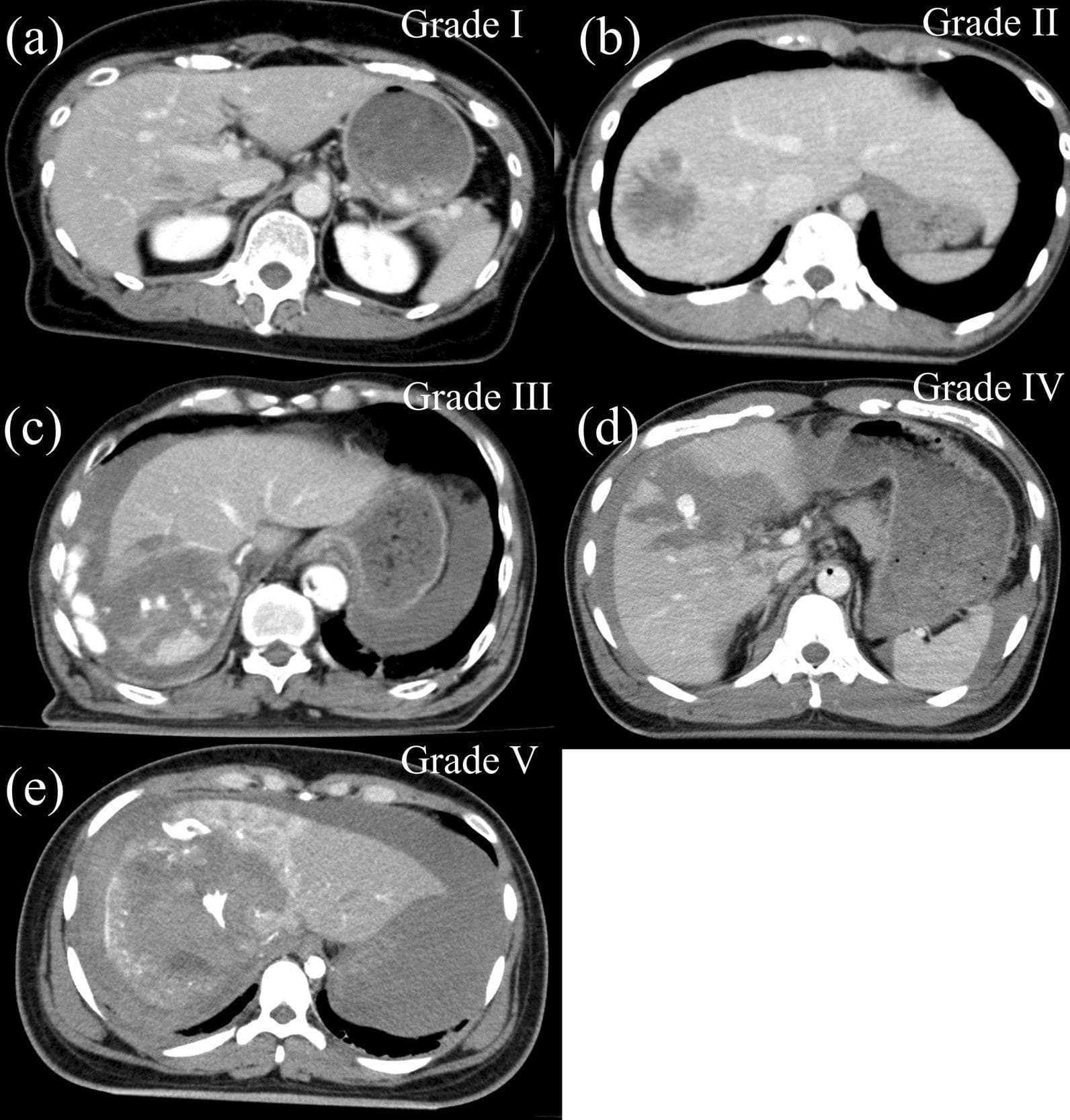 This composite diagnostic image presents five axial contrast-enhanced abdominal CT scans (labeled a-e) illustrating the AAST grading scale for blunt liver trauma. (a) Grade I: Shows a superficial laceration (<1 cm depth) or a small subcapsular hematoma involving <10% of the surface area. (b) Grade II: Demonstrates a deeper laceration (1–3 cm) or an intraparenchymal hematoma. (c) Grade III: Displays a large laceration (>3 cm depth) or a hematoma >10 cm in diameter, often with active intraparenchymal bleeding or extravasation of contrast. (d) Grade IV: Exhibits significant parenchymal disruption involving 25–75% of a hepatic lobe, showing extensive mottled density. (e) Grade V: Represents severe injury with parenchymal disruption exceeding 75% of a lobe, often accompanied by major venous injuries. The progression from Grade I to V is visually characterized by increasing heterogeneity of the liver parenchyma, loss of vascular architecture, larger areas of hypoattenuating lacerations/hematomas, and more extensive perihepatic fluid accumulation (hemoperitoneum).